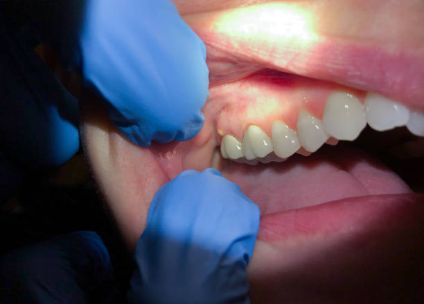 Best Emergency Tooth Extraction in Salem, WV